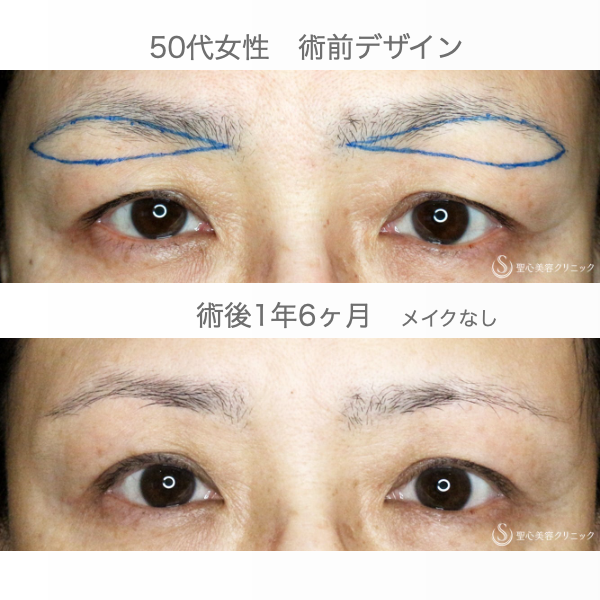 【50代女性・まぶたの自然な若返り】眉下リフト+α単独（1年6ヶ月後） After 