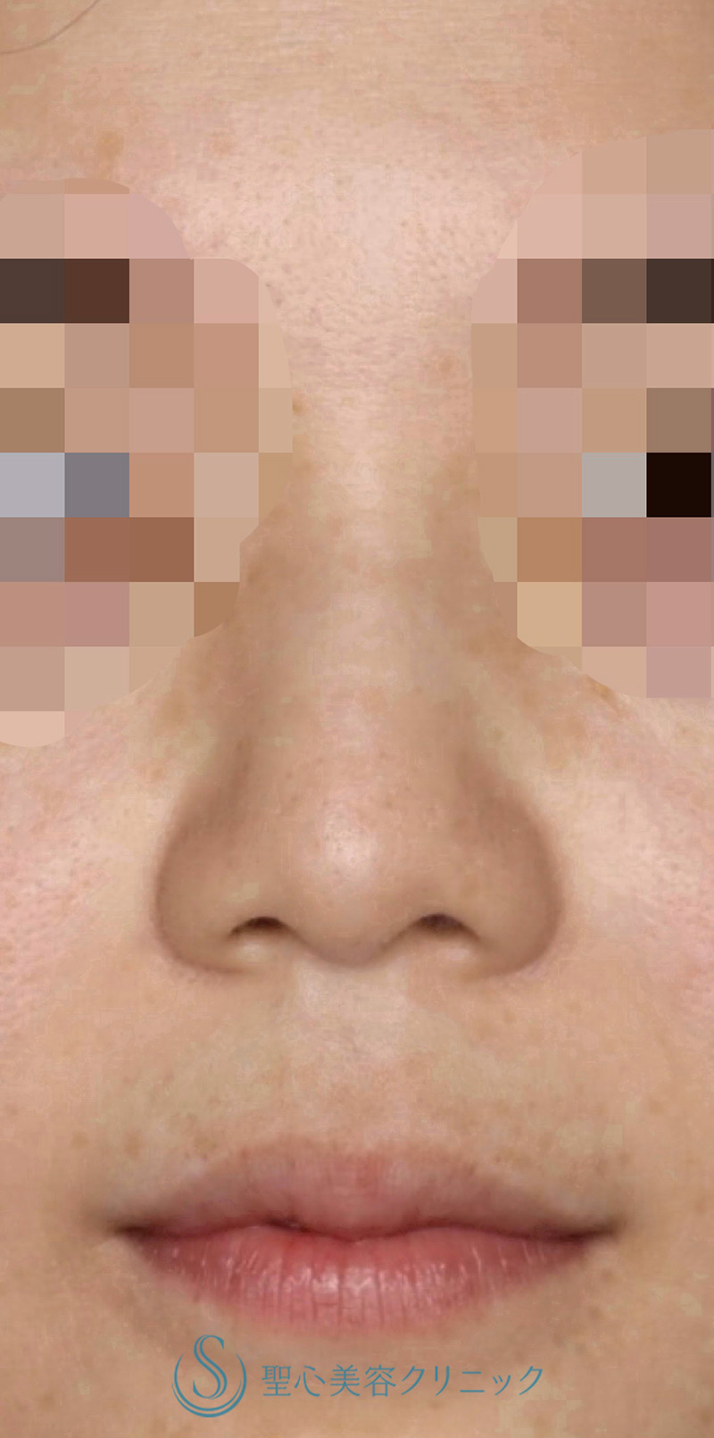 【30代女性・周りにバレない程度で鼻先をナチュラルにバランス良くスッキリ！！】鼻尖縮小＋鼻尖形成（耳介軟骨移植・ストラット法）（術後8ヶ月） Before 