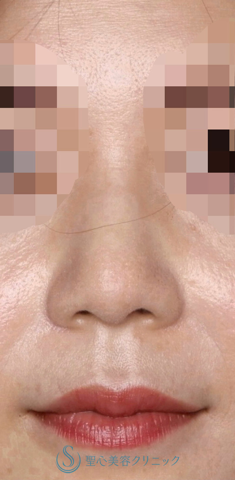 【30代女性・周りにバレない程度で鼻先をナチュラルにバランス良くスッキリ！！】鼻尖縮小＋鼻尖形成（耳介軟骨移植・ストラット法）（術後8ヶ月） After 
