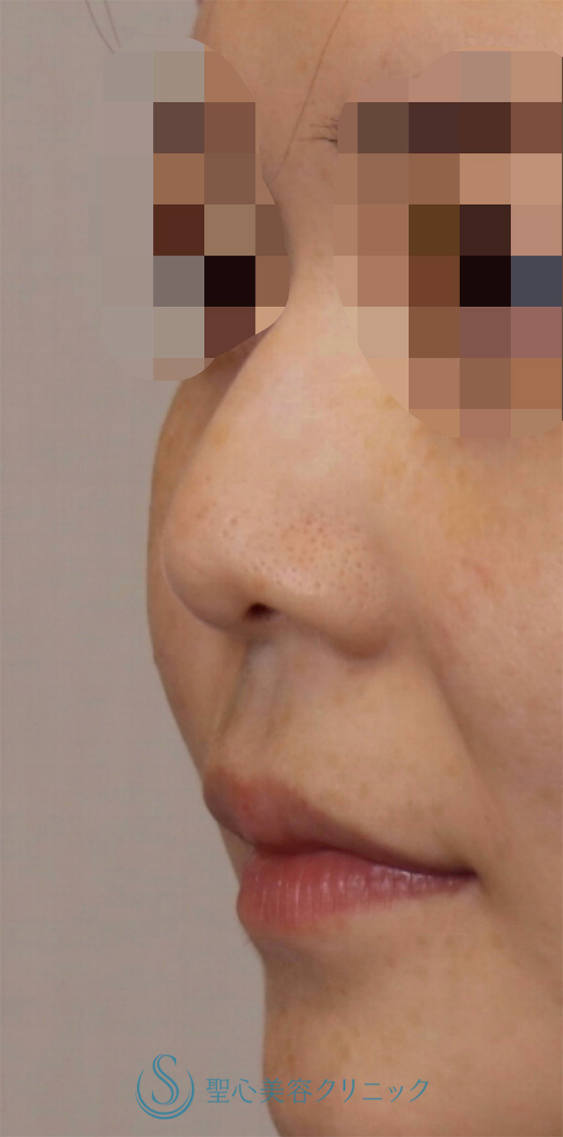 【30代女性・周りにバレない程度で鼻先をナチュラルにバランス良くスッキリ！！】鼻尖縮小＋鼻尖形成（耳介軟骨移植・ストラット法）（術後8ヶ月） Before 