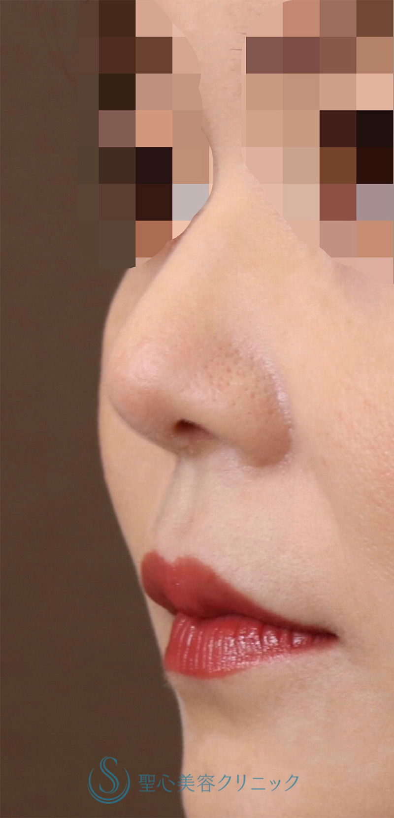 【30代女性・周りにバレない程度で鼻先をナチュラルにバランス良くスッキリ！！】鼻尖縮小＋鼻尖形成（耳介軟骨移植・ストラット法）（術後8ヶ月） After 