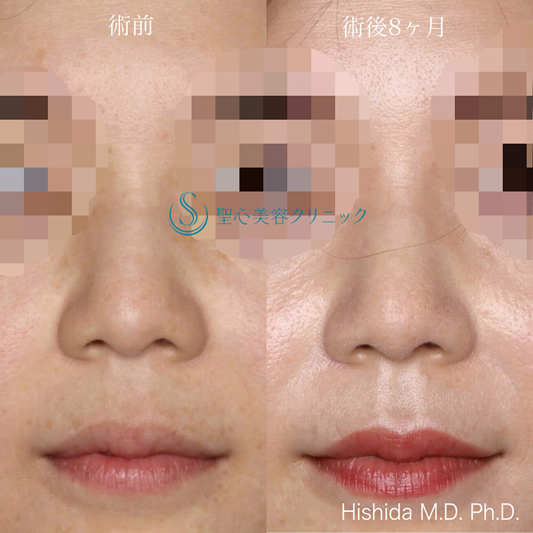 【30代女性・周りにバレない程度で鼻先をナチュラルにバランス良くスッキリ！！】鼻尖縮小＋鼻尖形成（耳介軟骨移植・ストラット法）（術後8ヶ月） After 