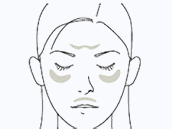 肝斑（かんぱん）治療