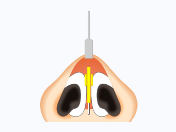 鼻中隔延長術