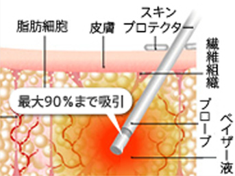 最大90%まで吸引