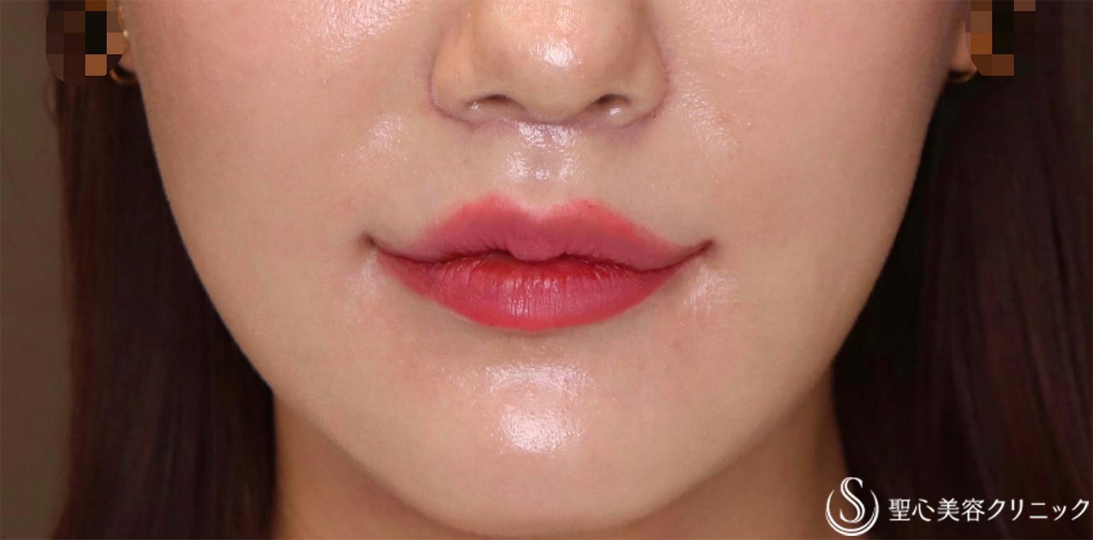 【30代女性・人中をできるだけ短くしたい！！】プレミアムリップリフト（プレミアム人中短縮術）＋プレミアム口角挙上術（術後1.5ヶ月） After 