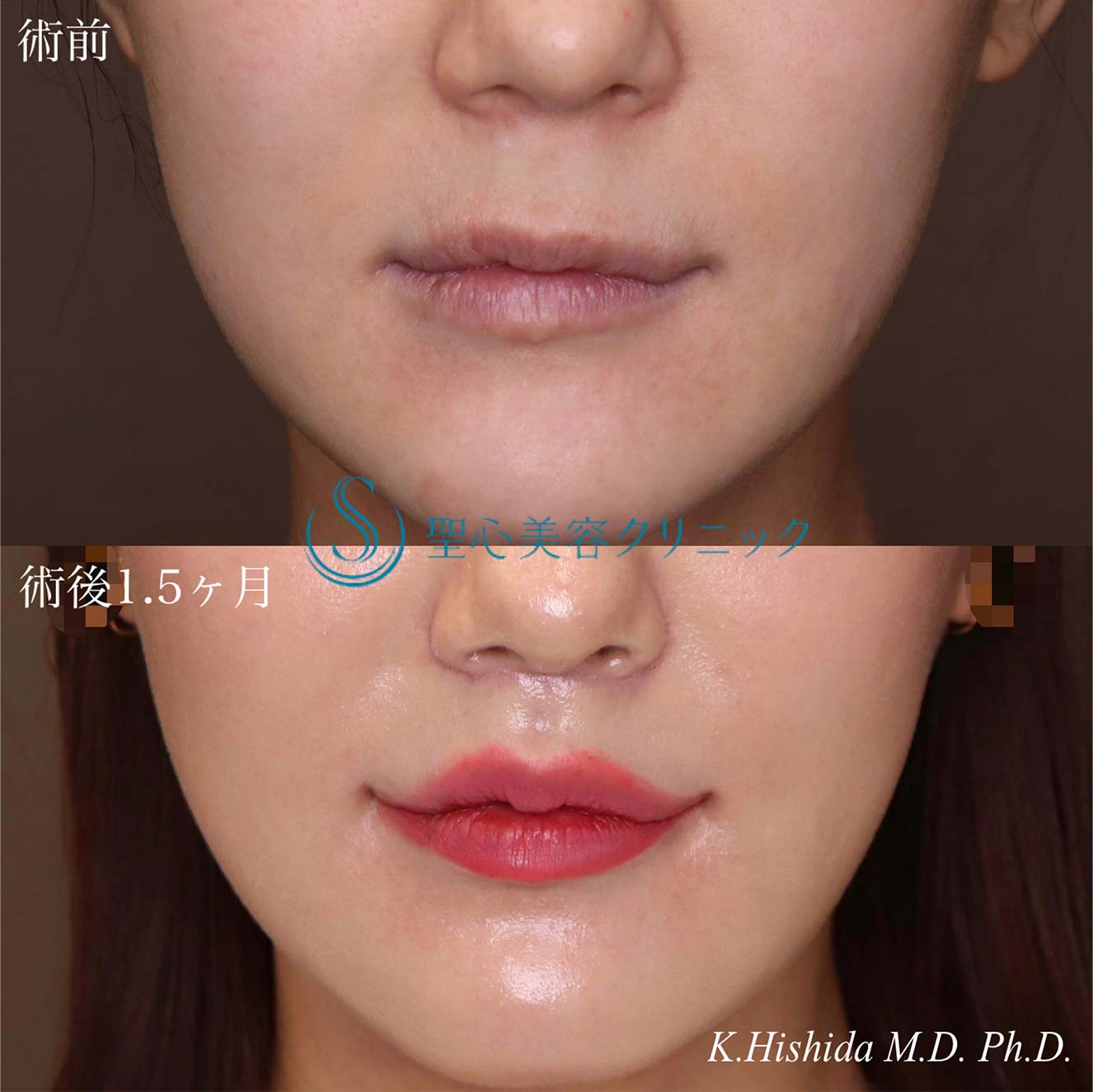 【30代女性・人中をできるだけ短くしたい！！】プレミアムリップリフト（プレミアム人中短縮術）＋プレミアム口角挙上術（術後1.5ヶ月） After 