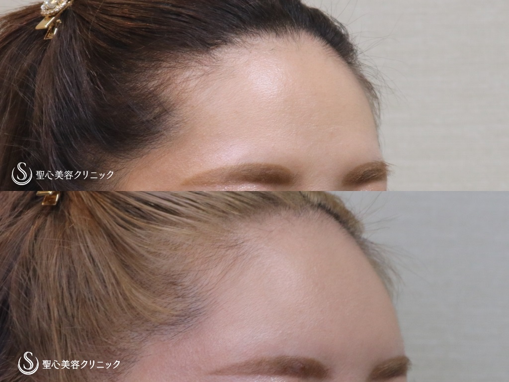 【30代女性・額をふっくらと可愛らしく】プレミアムPRP皮膚再生療法（半年後） Before 