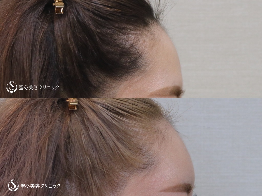 【30代女性・額をふっくらと可愛らしく】プレミアムPRP皮膚再生療法（半年後） Before 