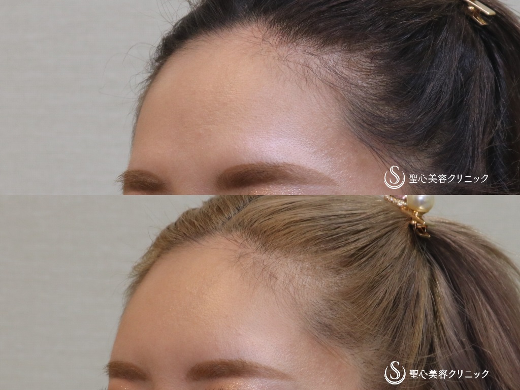 【30代女性・額をふっくらと可愛らしく】プレミアムPRP皮膚再生療法（半年後） After 