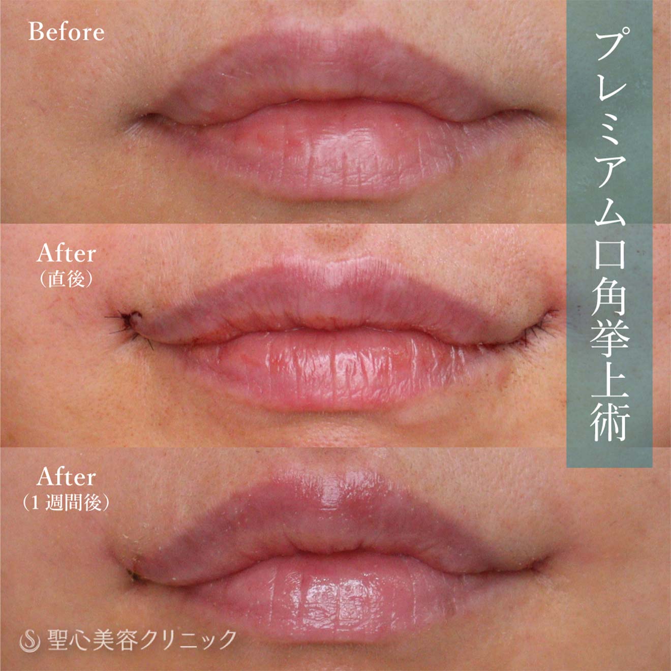 【40代女性・口角】プレミアム口角挙上(3か月後・6か月後) - 症例写真 - 美容整形、美容外科なら聖心美容クリニック