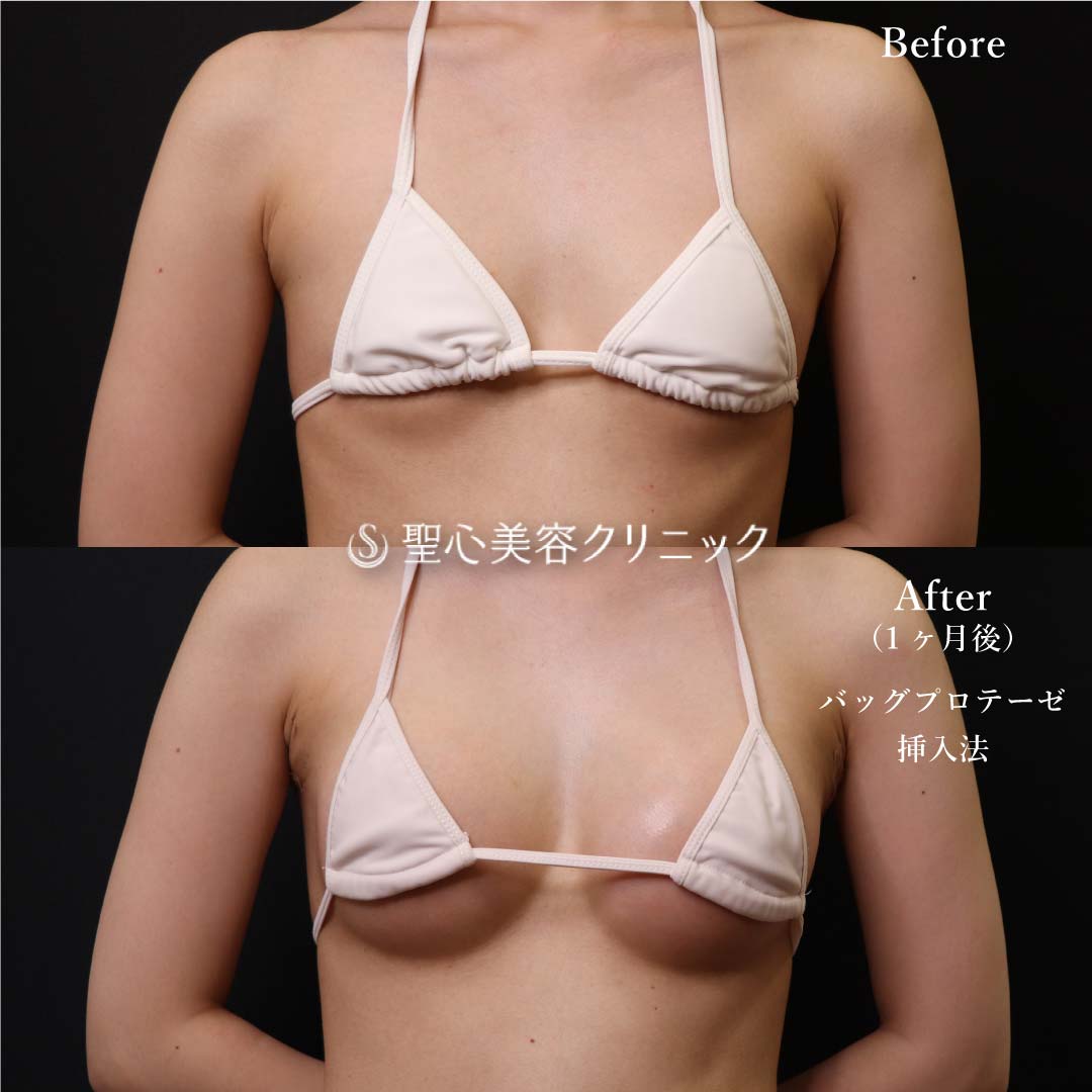 【20代女性・豊胸】Motiva Demi230cc.（1ヶ月後） Before 