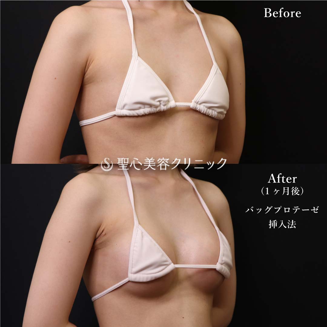【20代女性・豊胸】Motiva Demi230cc.（1ヶ月後） After 