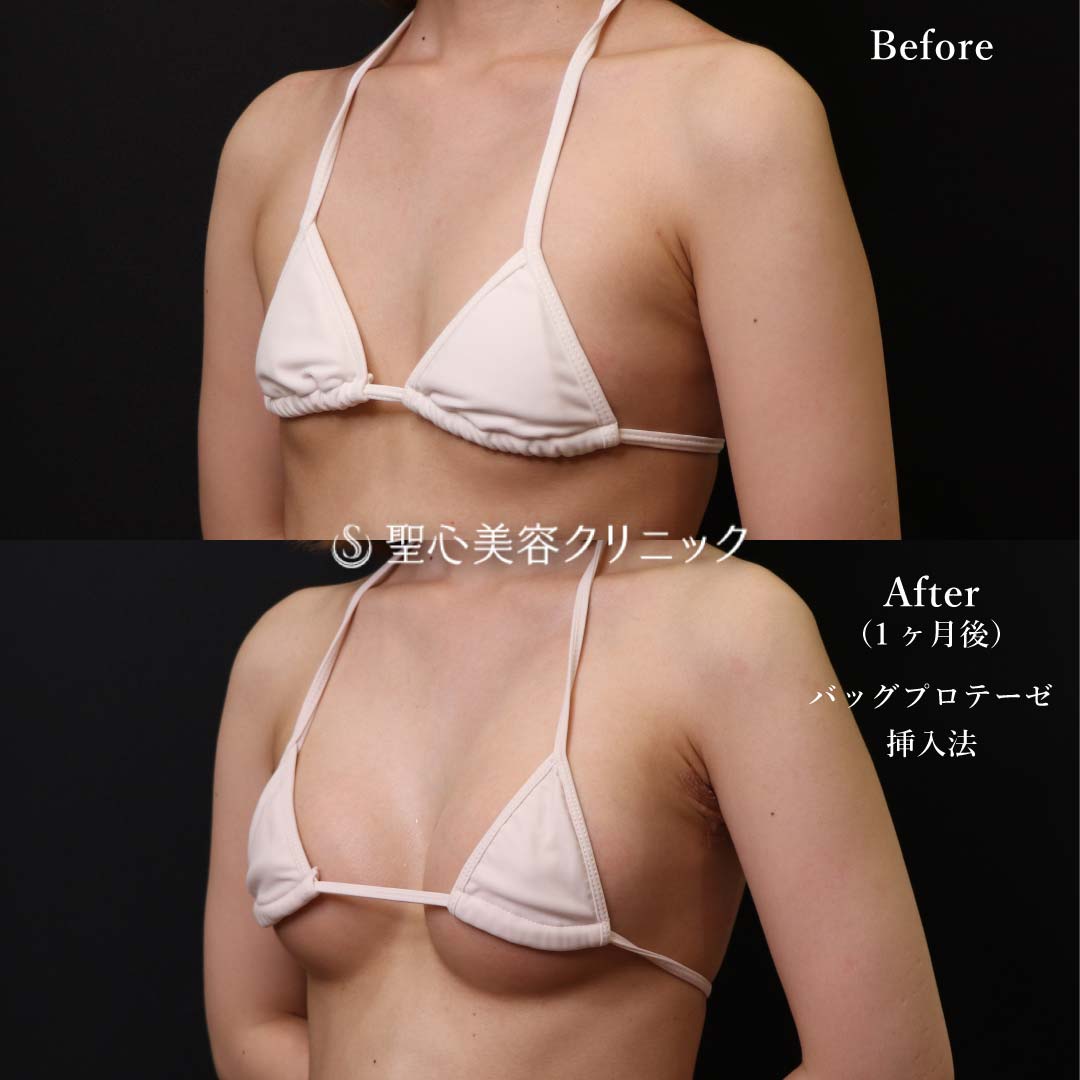 【20代女性・豊胸】Motiva Demi230cc.（1ヶ月後） After 