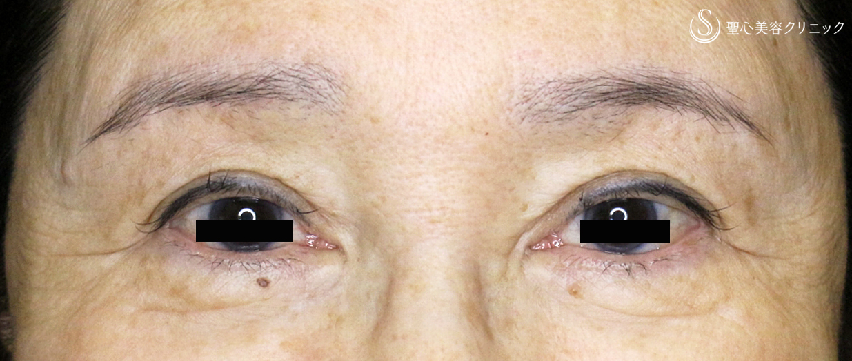 【60代女性・上まぶたのタルミ】眉下リフト単独例（9年後） After 