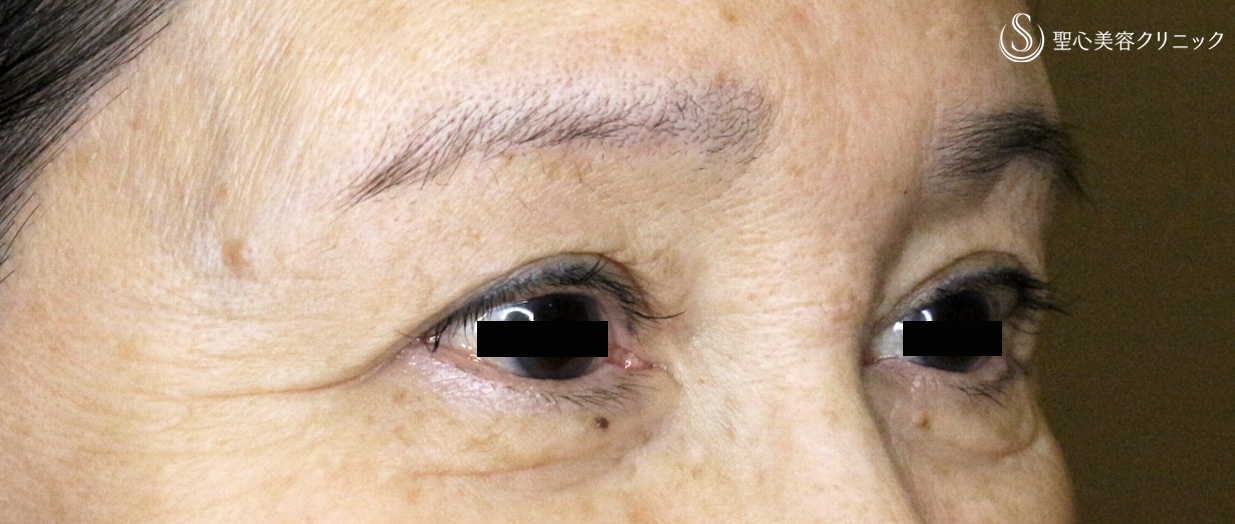 【60代女性・上まぶたのタルミ】眉下リフト単独例（9年後） After 