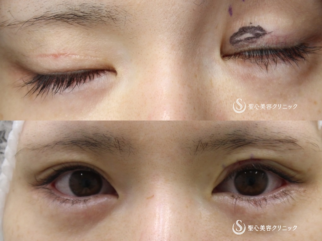 【30代女性・右目の被さり、左の目頭部分のハム目修正】二重切開後修正（二重幅修正、睫毛上皮膚切除）（右目2ヶ月半、左目1ヶ月半） Before 