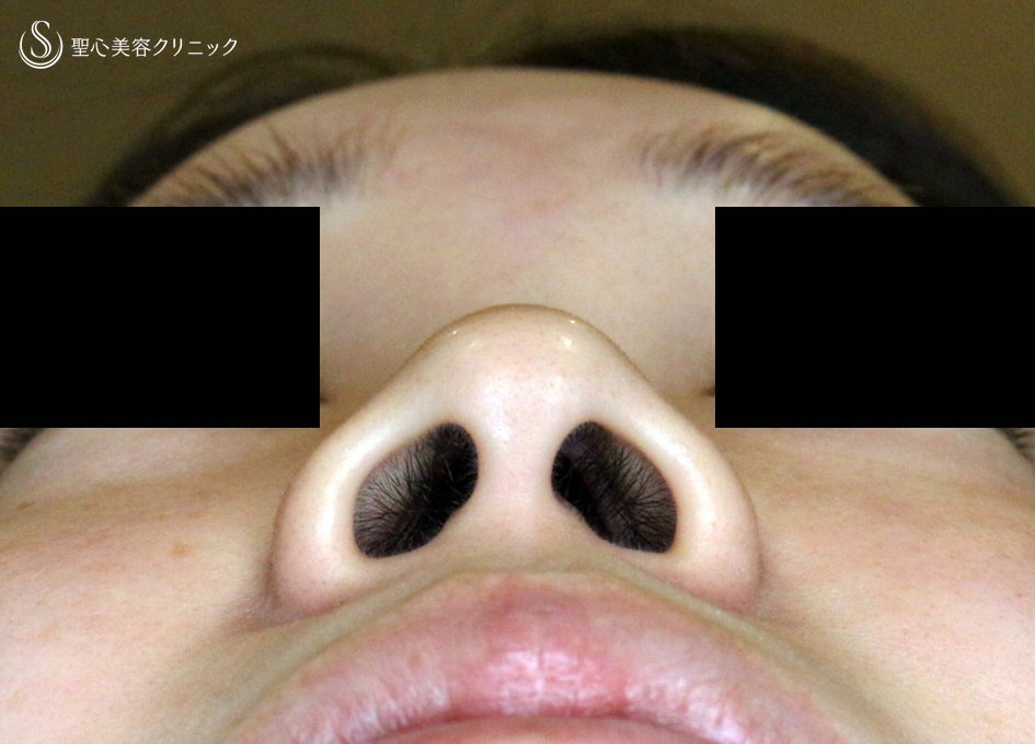 【20代女性・スマートな小鼻で「忘れ鼻」】小鼻縮小術+α法「Ver.6 」＆Gメッシュ（3ヶ月後） Before 