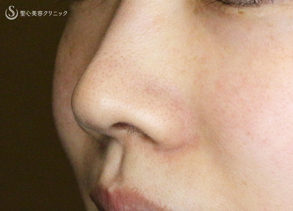 【20代女性・スマートな小鼻で「忘れ鼻」】小鼻縮小術+α法「Ver.6 」＆Gメッシュ（3ヶ月後） Before 