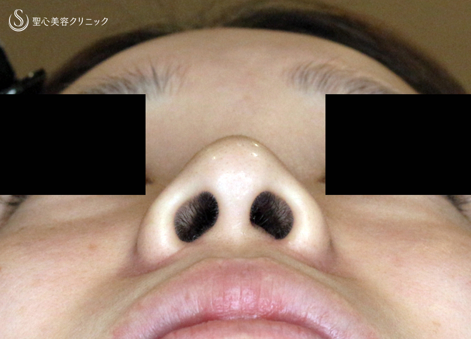 【20代女性・スマートな小鼻で「忘れ鼻」】小鼻縮小術+α法「Ver.6 」＆Gメッシュ（3ヶ月後） After 