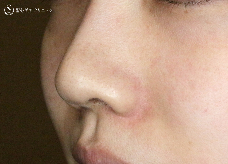 【20代女性・スマートな小鼻で「忘れ鼻」】小鼻縮小術+α法「Ver.6 」＆Gメッシュ（3ヶ月後） After 