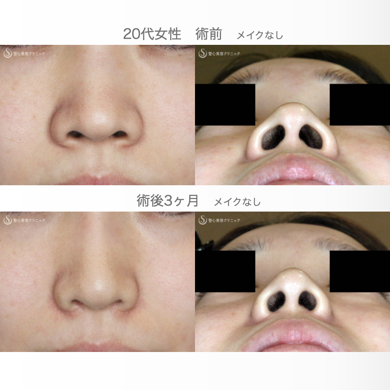 【20代女性・スマートな小鼻で「忘れ鼻」】小鼻縮小術+α法「Ver.6 」＆Gメッシュ（3ヶ月後） Before 