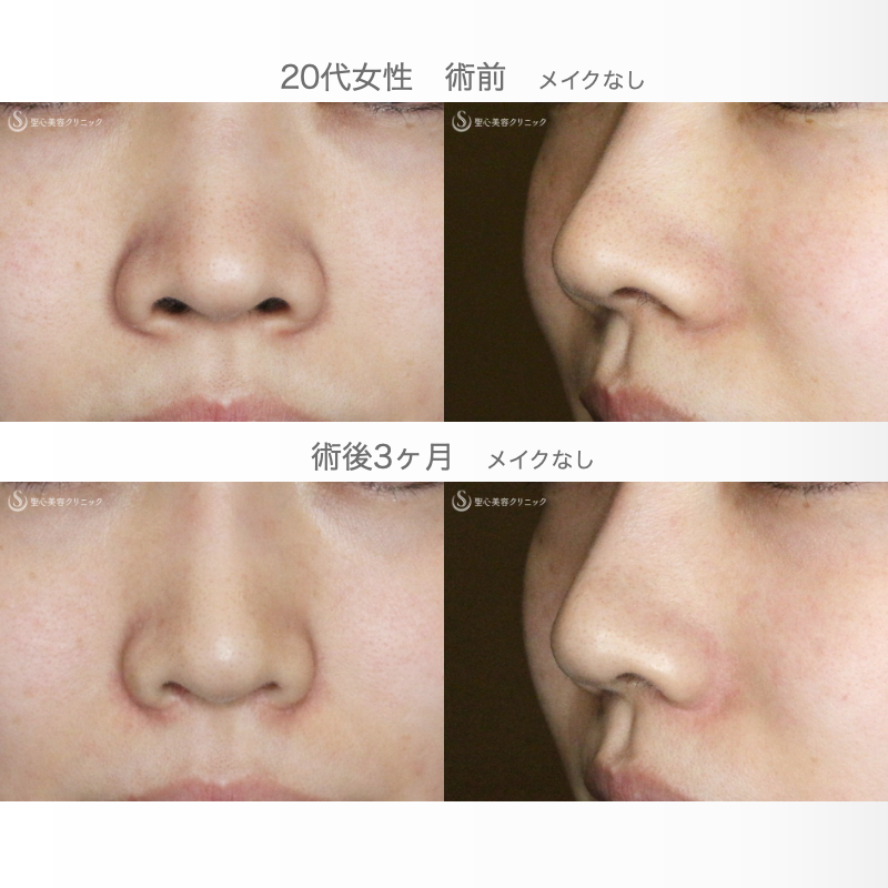 【20代女性・スマートな小鼻で「忘れ鼻」】小鼻縮小術+α法「Ver.6 」＆Gメッシュ（3ヶ月後） Before 