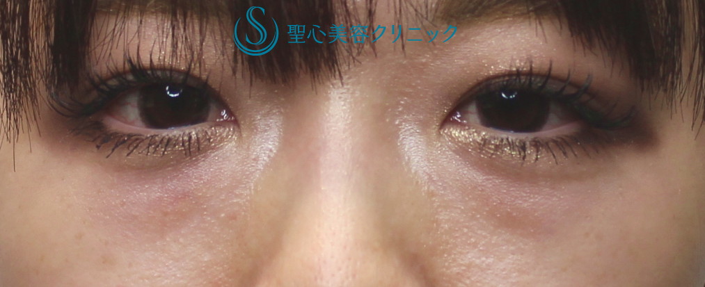 【30代女性・目の下のクマ（膨らみ）】経結膜脱脂術（目の下の脂肪取り）（1ヶ月後） Before 