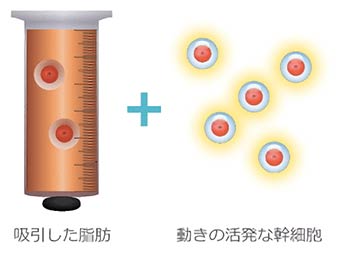 セリューション乳房再建術（脂肪由来幹細胞移植）