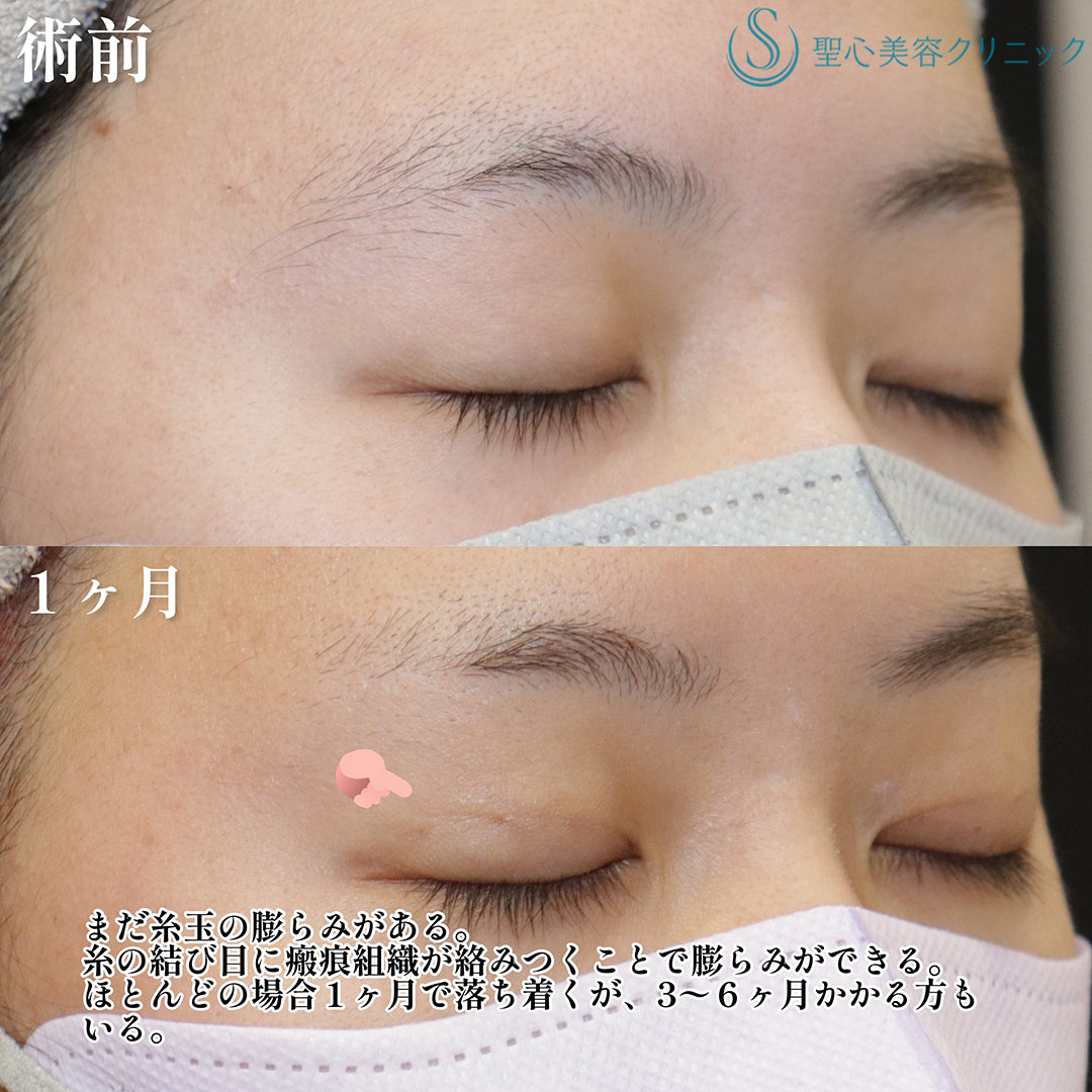 【20代女性・マイクロメソッドで華やかなお目元へ】 二重術（埋没法）：マイクロメソッド+α（1ヶ月後） Before 