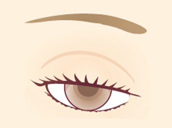 眼瞼下垂治療（腱膜縫縮法）