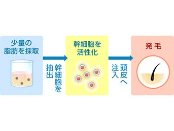 KERASTEM（ケラステム）毛髪再生