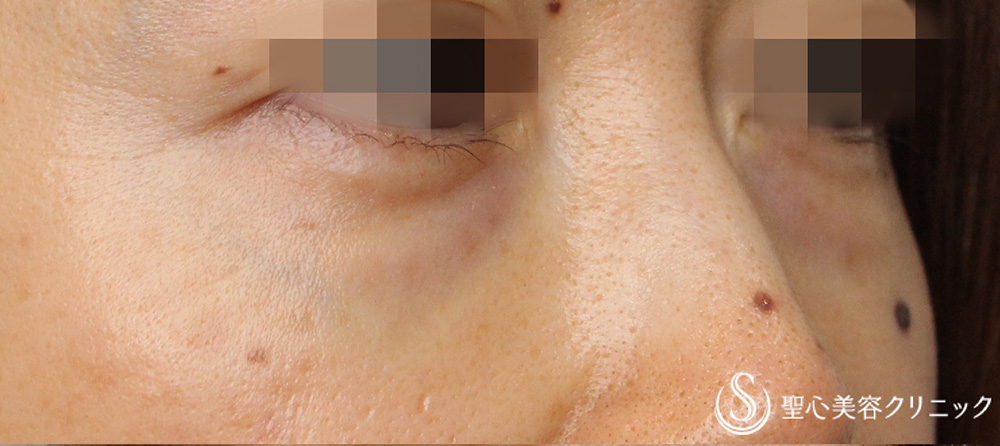 【30代女性・目の下のクマ】 目の下の脂肪取り（経結膜下脱脂術）（ 2ヶ月後） Before 