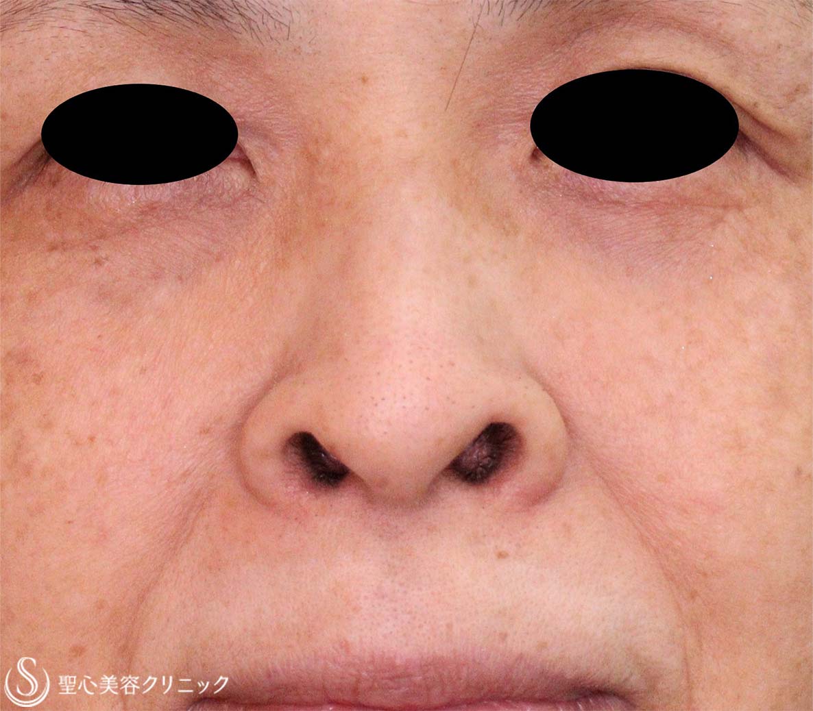 【60代女性・鼻孔の形】鼻孔縁下降術（術後6日、1か月） Before 