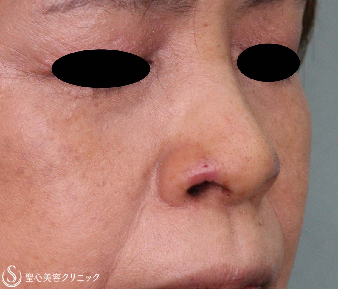 【60代女性・鼻孔の形】鼻孔縁下降術（術後6日、1か月） After 