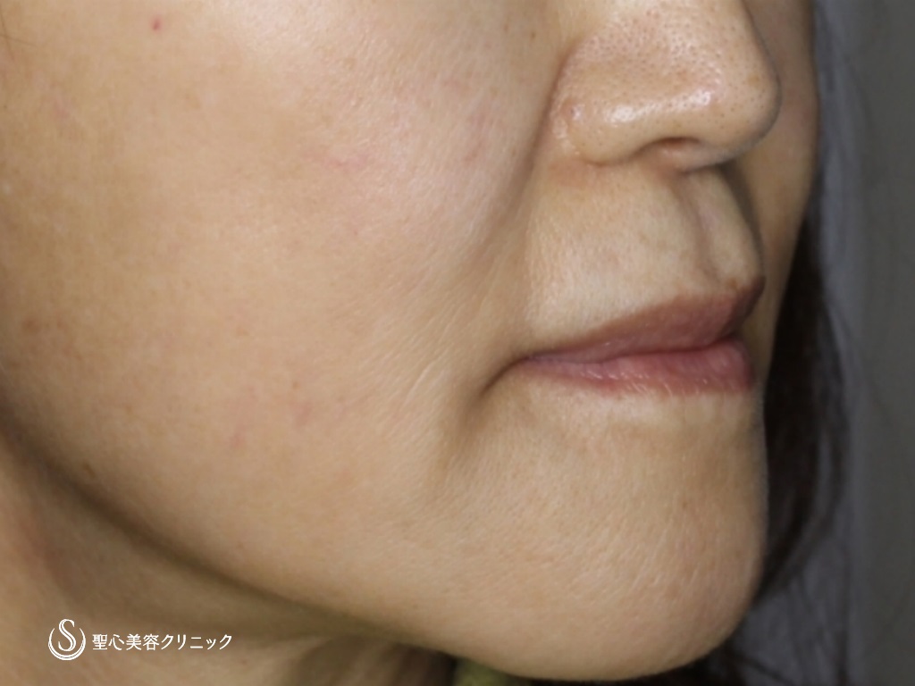 【60代女性・口元付近を若々しく】リップリフト+プレミアム口角挙上（2か月後） Before 