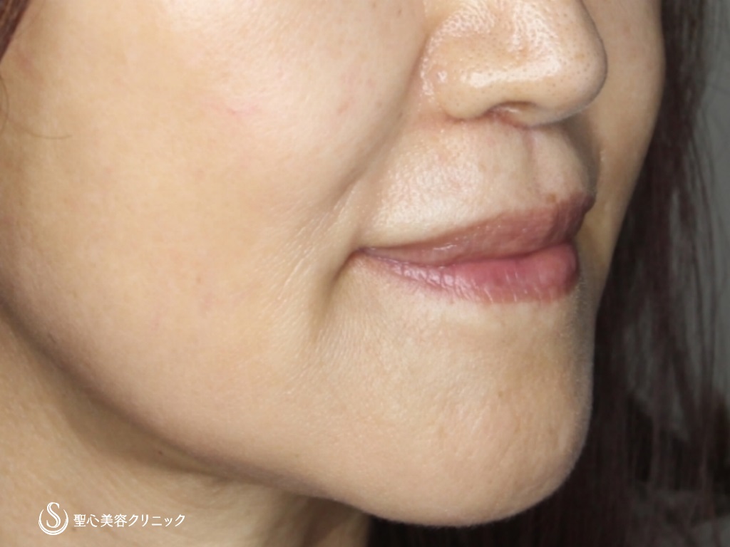 【60代女性・口元付近を若々しく】リップリフト+プレミアム口角挙上（2か月後） After 