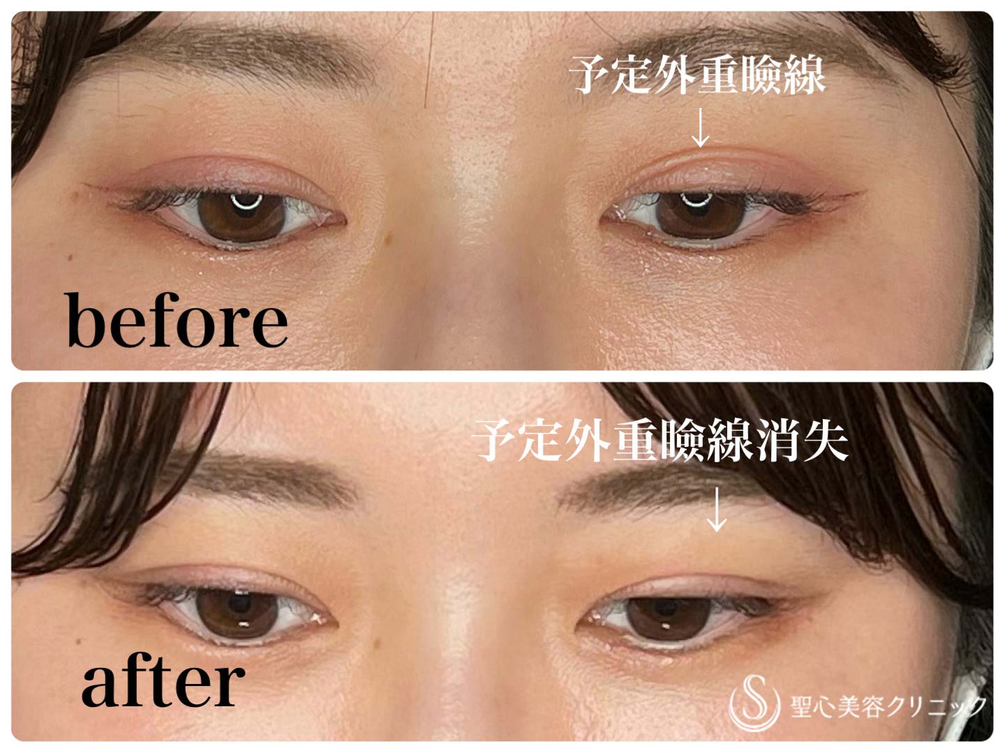 【20代女性・三重を解消】他院二重切開後予定外重瞼線修正（ヒアルロン酸注入）（処置後1時間） Before 