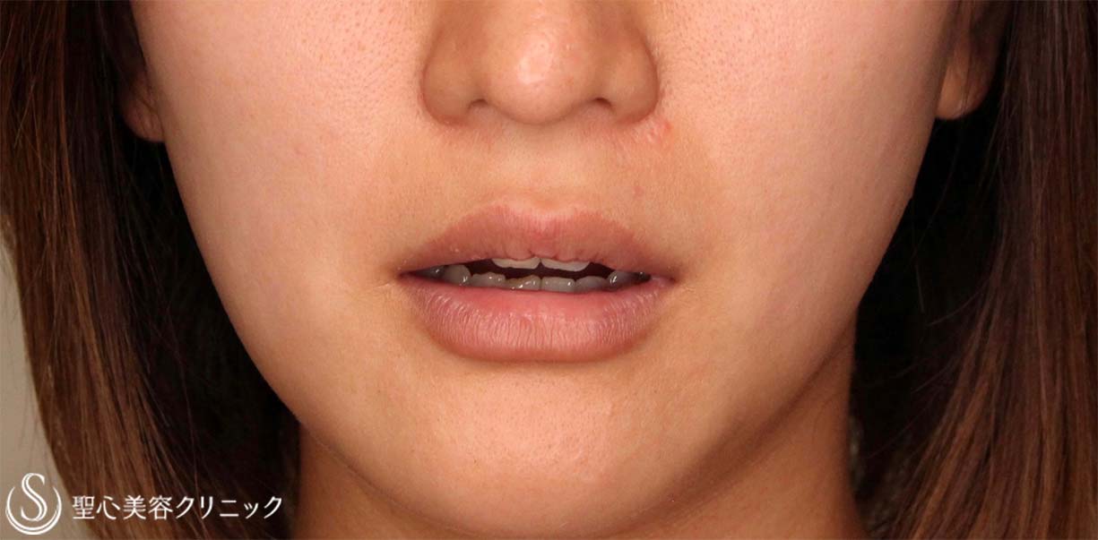 【20代女性・人中を短くしたい！！】プレミアムリップリフト（プレミアム人中短縮術）（術後7日（抜糸時）） Before 