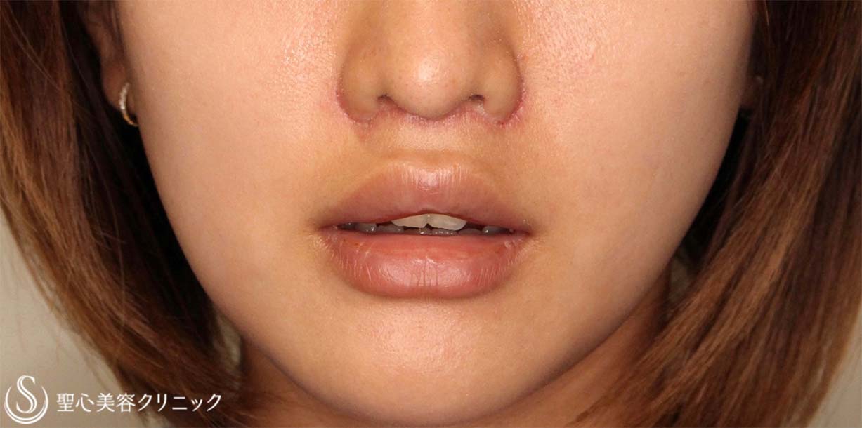 【20代女性・人中を短くしたい！！】プレミアムリップリフト（プレミアム人中短縮術）（術後7日（抜糸時）） After 