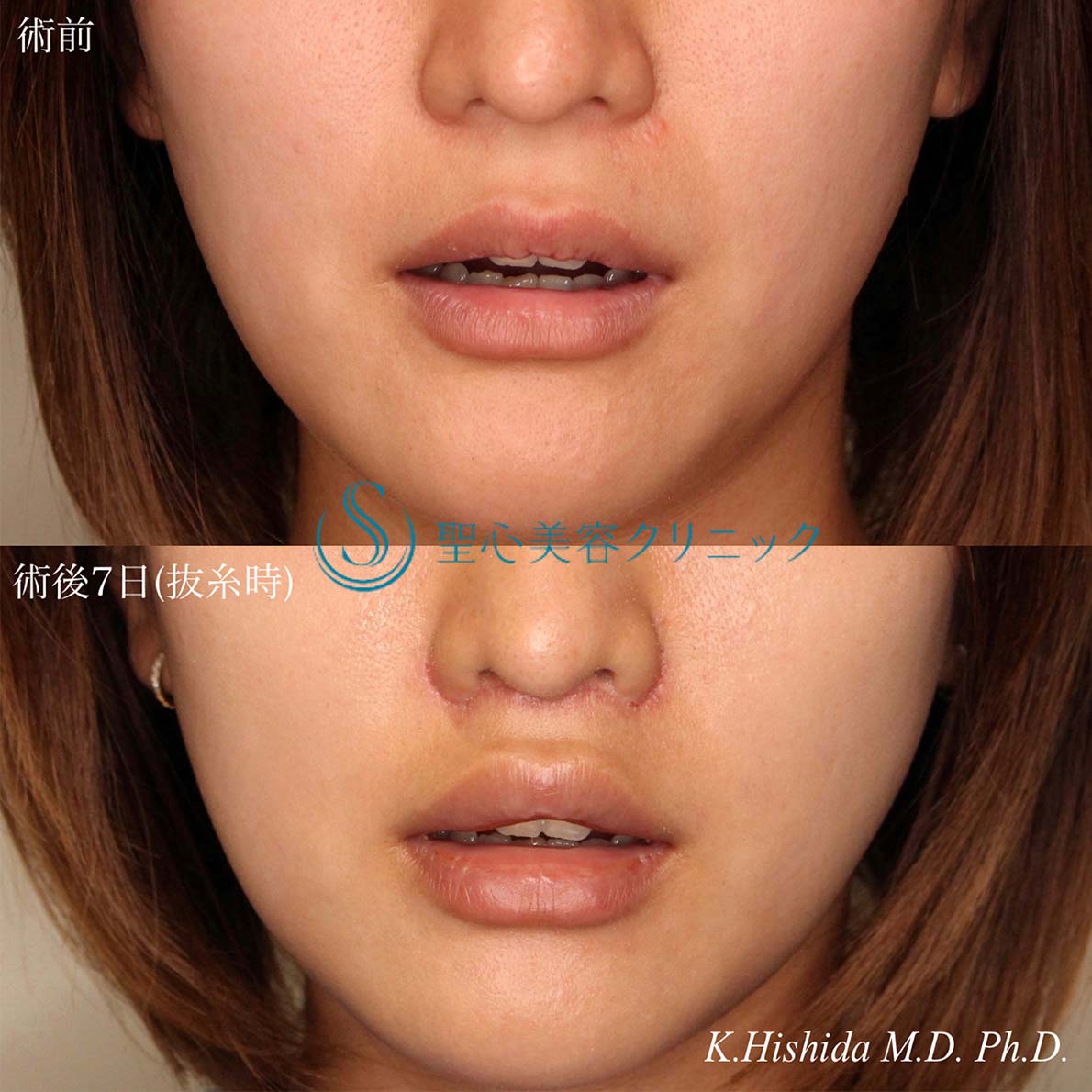 【20代女性・人中を短くしたい！！】プレミアムリップリフト（プレミアム人中短縮術）（術後7日（抜糸時）） After 