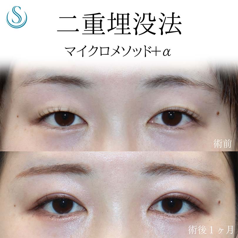 【20代女性・埋没法で目をぱっちりと】二重術（埋没法）：マイクロメソッド+α（術後1ヶ月） Before 