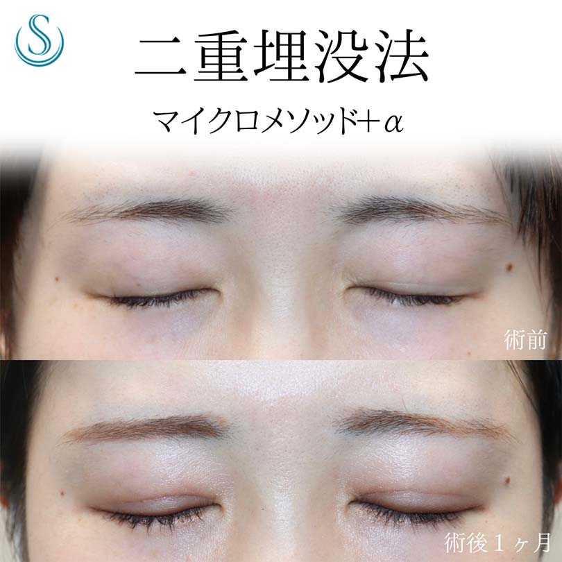 【20代女性・埋没法で目をぱっちりと】二重術（埋没法）：マイクロメソッド+α（術後1ヶ月） After 