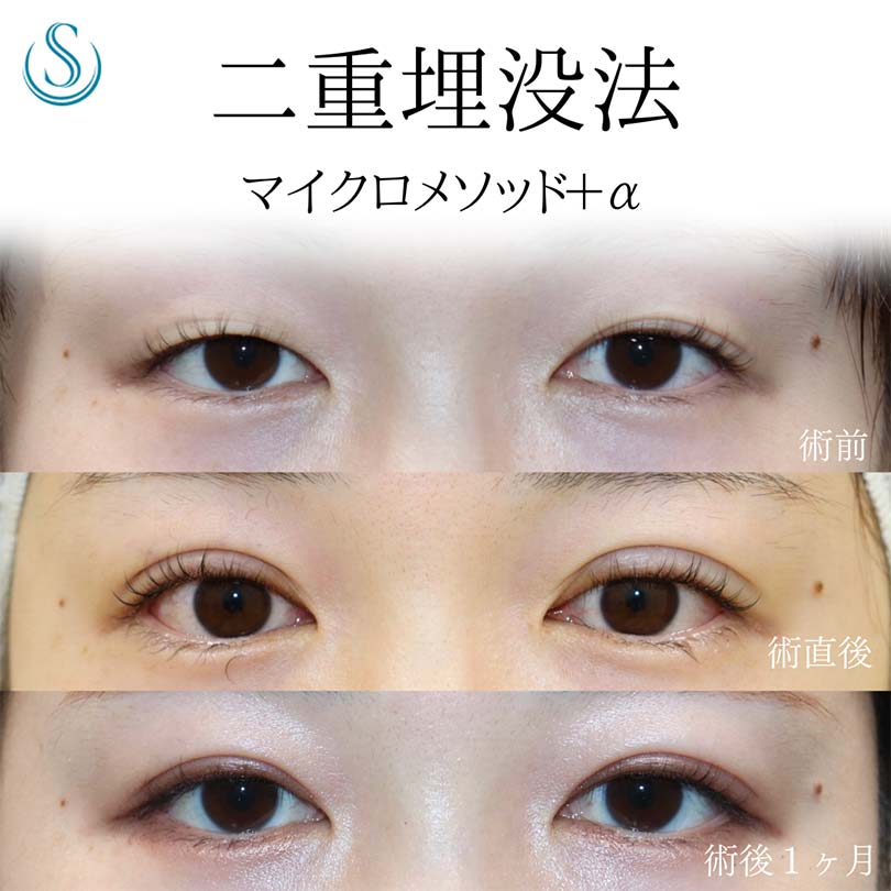 【20代女性・埋没法で目をぱっちりと】二重術（埋没法）：マイクロメソッド+α（術後1ヶ月） After 