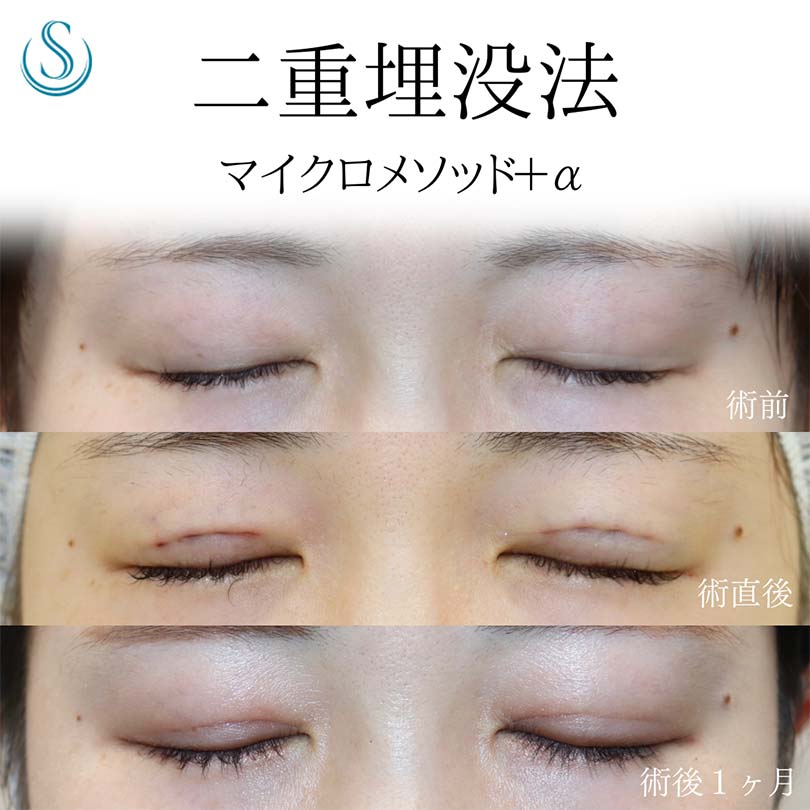 【20代女性・埋没法で目をぱっちりと】二重術（埋没法）：マイクロメソッド+α（術後1ヶ月） After 
