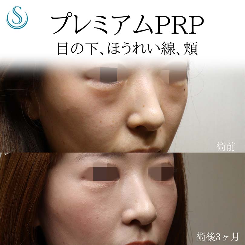 【20代女性・プレミアムPRPでクマ、コケを改善】プレミアムPRP皮膚再生療法（術後3ヶ月） Before 