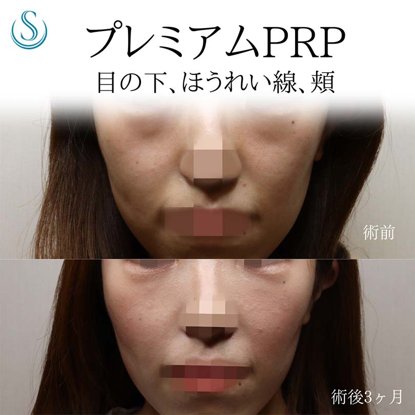 【20代女性・プレミアムPRPでクマ、コケを改善】プレミアムPRP皮膚再生療法（術後3ヶ月） After 