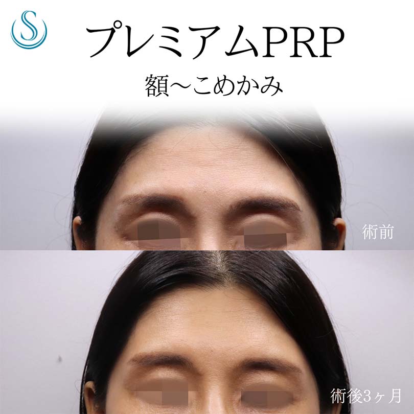 【40代女性・おでこからこめかみにかけてハリを】プレミアムPRP皮膚再生療法（術後3ヶ月） After 