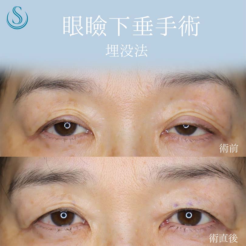 【50代女性・眼瞼下垂手術で目の開きを改善】眼瞼下垂（埋没法）（術直後） Before 