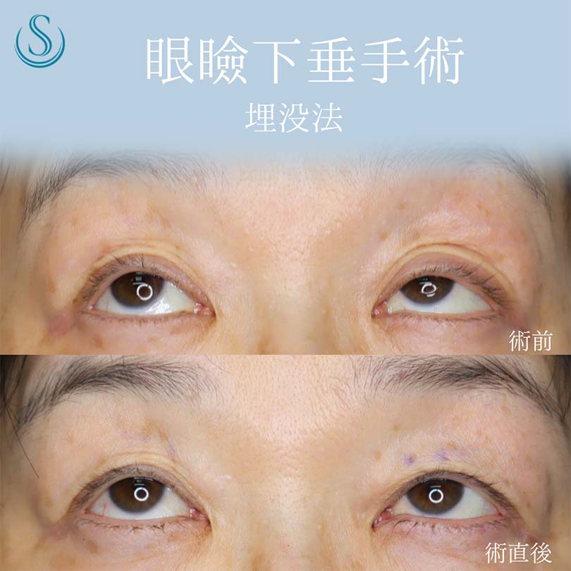 【50代女性・眼瞼下垂手術で目の開きを改善】眼瞼下垂（埋没法）（術直後） After 